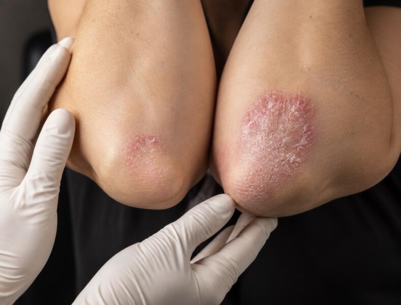 Che cosa è la psoriasi?